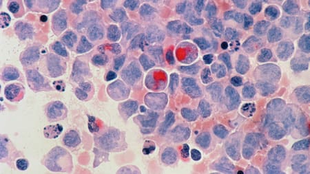 Cáncer. Foto: Unsplash