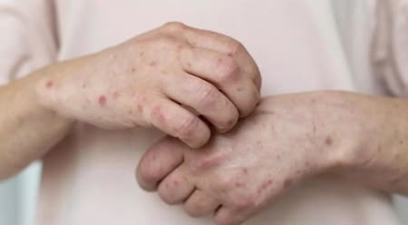 Urticaria crónica. Foto: Freepik