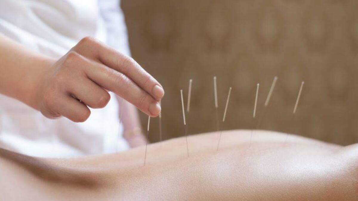 Acupuntura