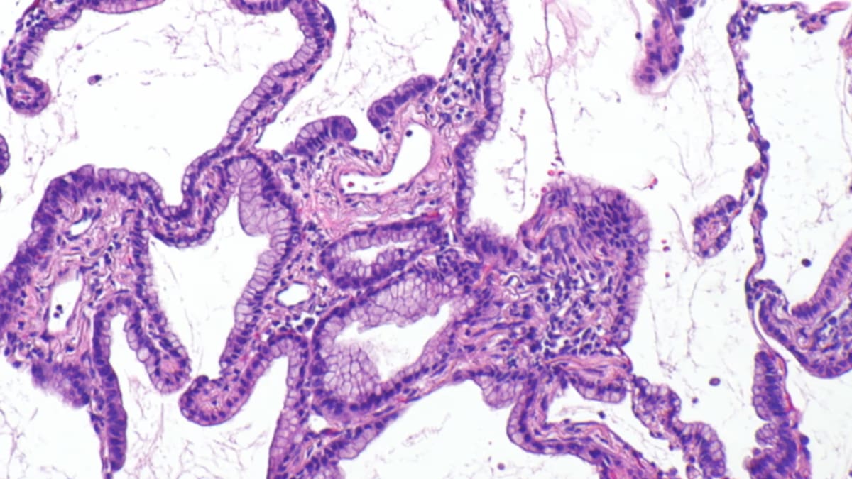Adenocarcinoma pulmonar