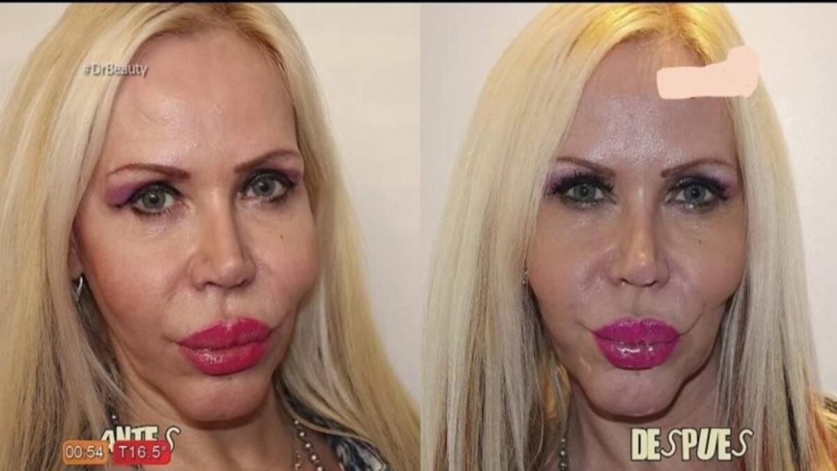 Alejandra Pradón reapareció en televisión con un rejuvenecimiento vaginal en vivo