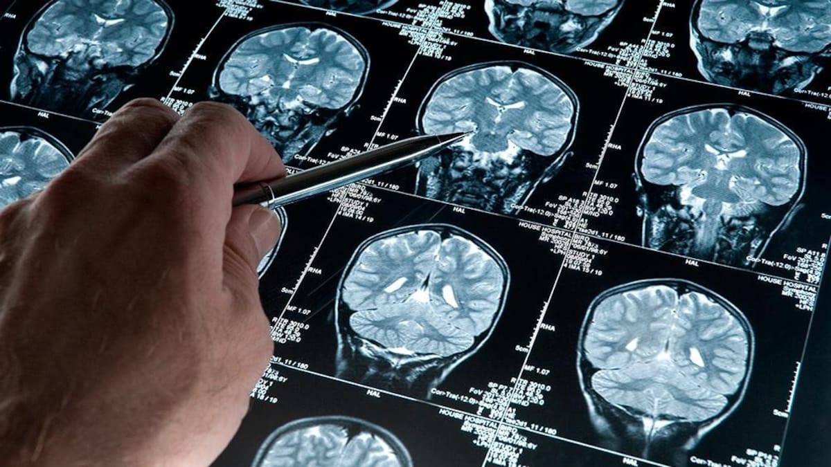 Alzheimer, estudios médicos