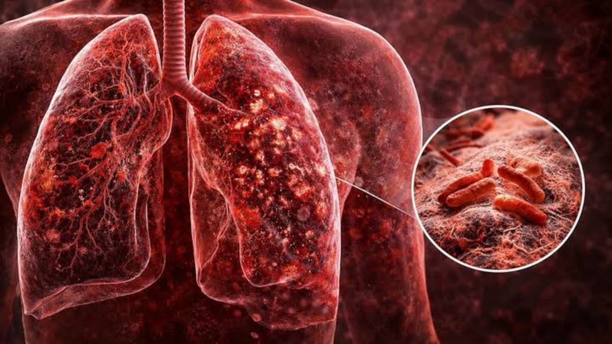 Preocupante avance de la tuberculosis en Argentina: se registraron 6.482 casos en lo que va del año