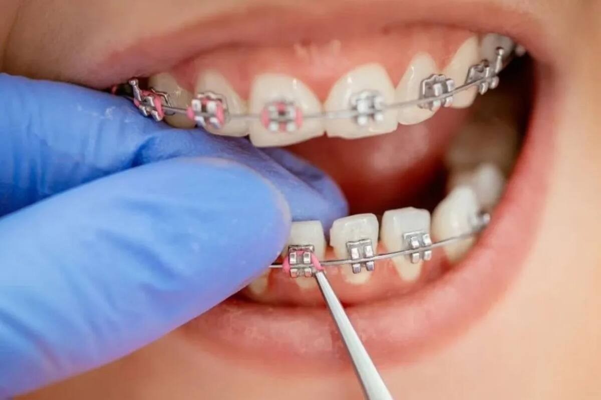 Brackets.