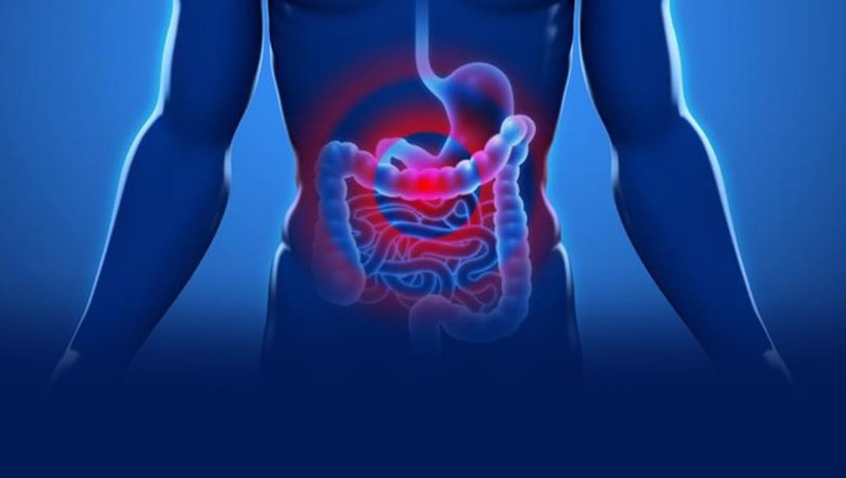 Cáncer de colon