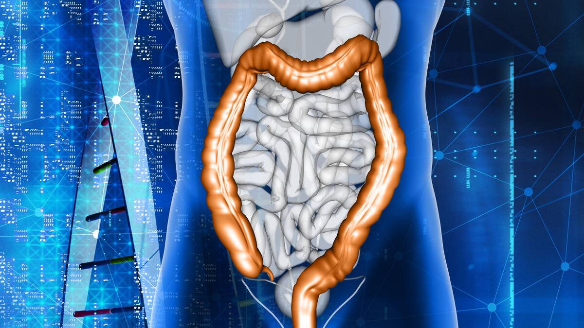Cáncer de Cólon. Freepik