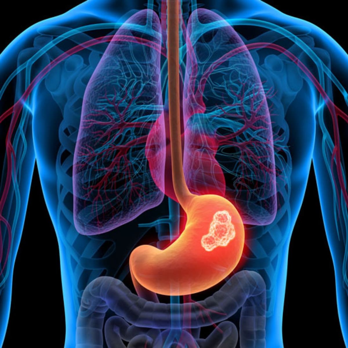 Cáncer de estómago.