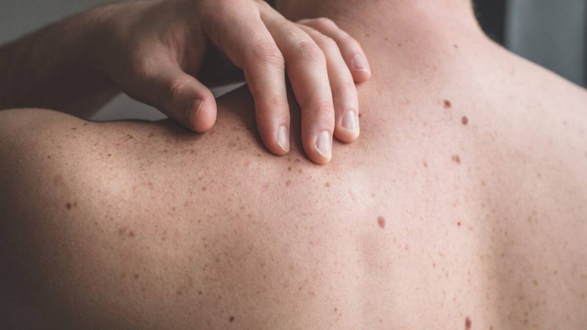 Cáncer de piel. Foto: EFE