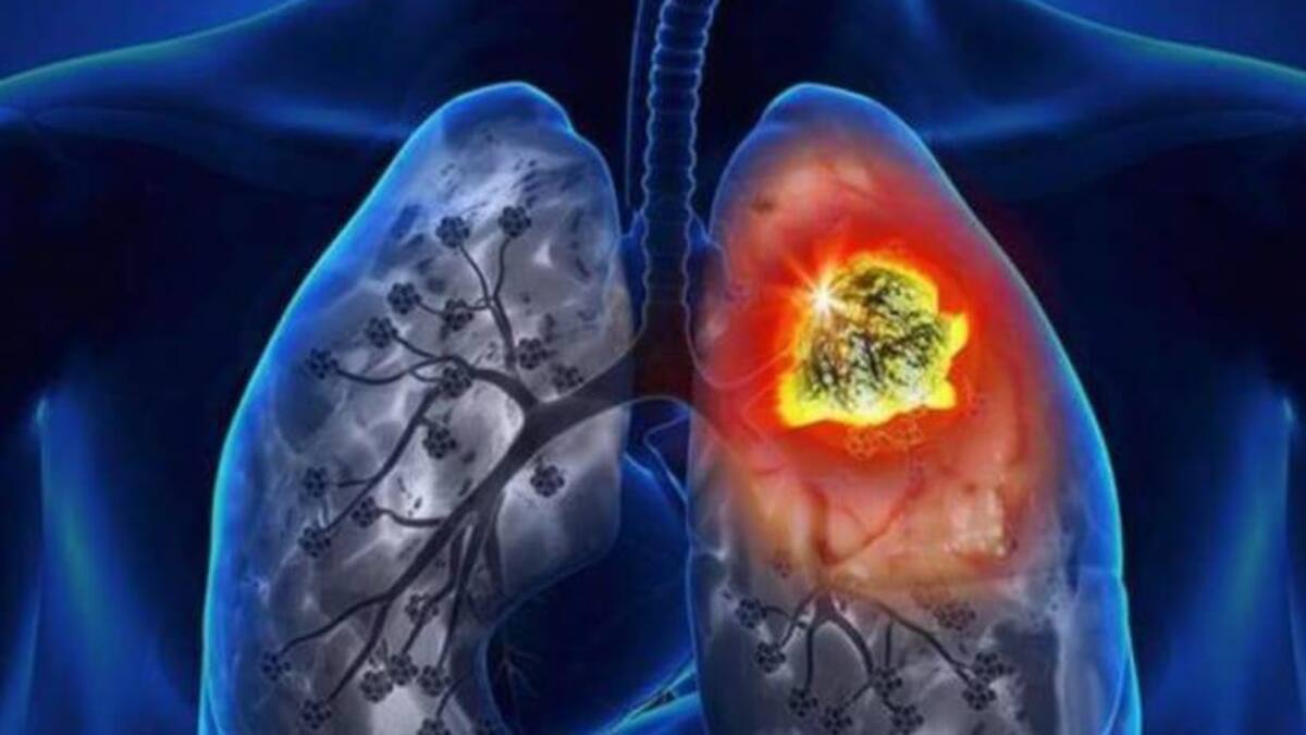 Cáncer de pulmón, salud