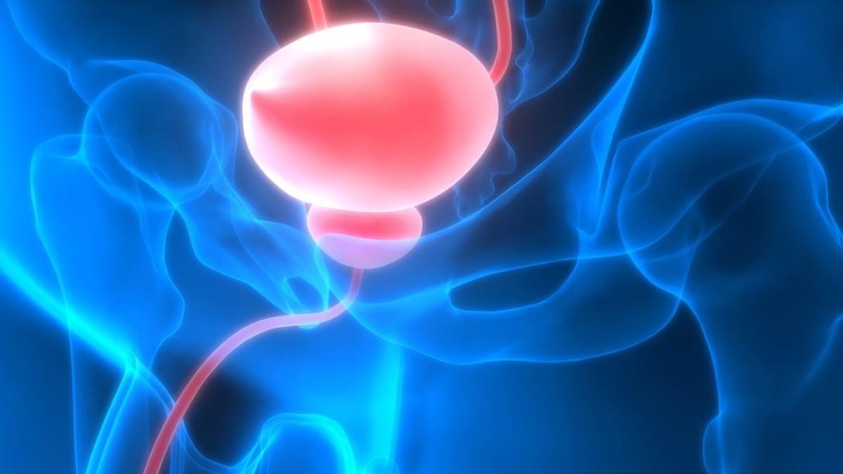 Cáncer de vejiga