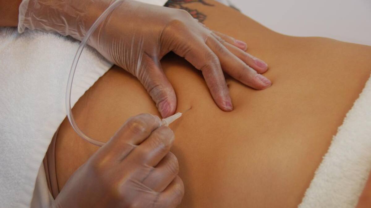 Carboxiterapia - salud