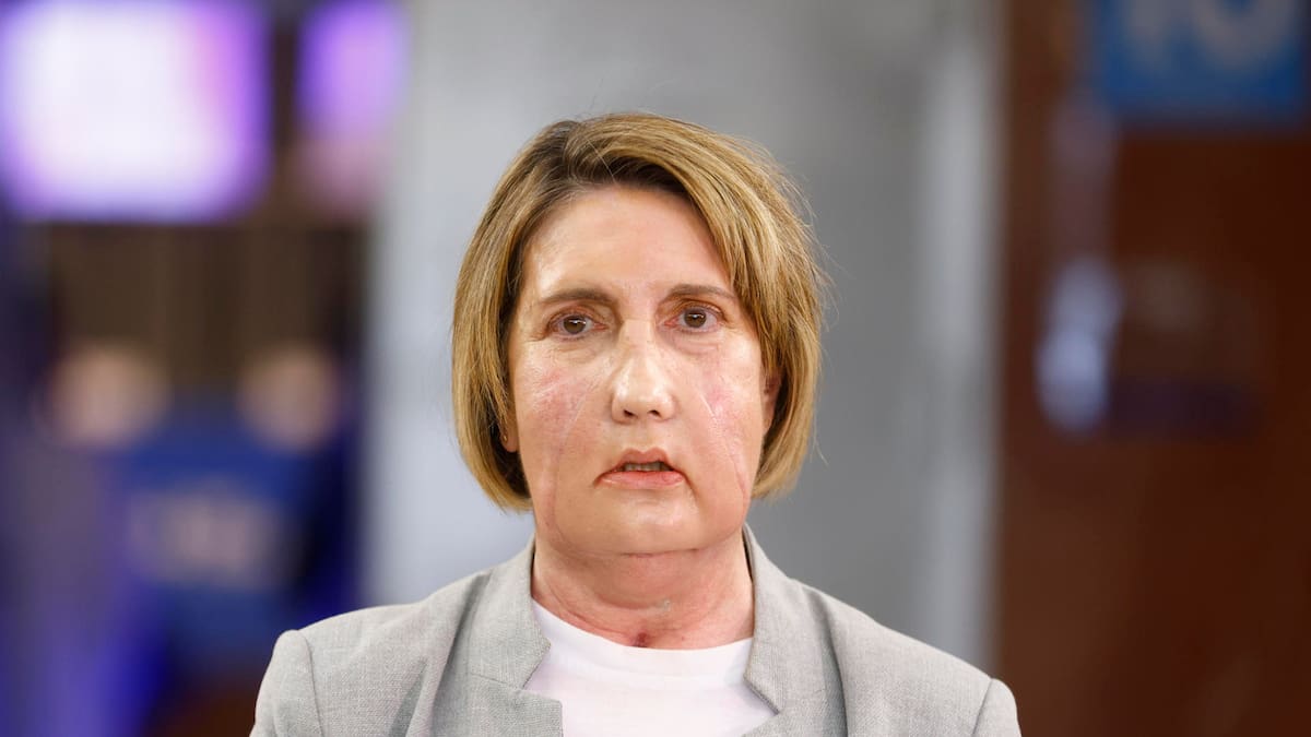 “Empiezo a parecerme a mí”: el caso de Carmen y el primer trasplante de cara del mundo a partir de una donación por eutanasia