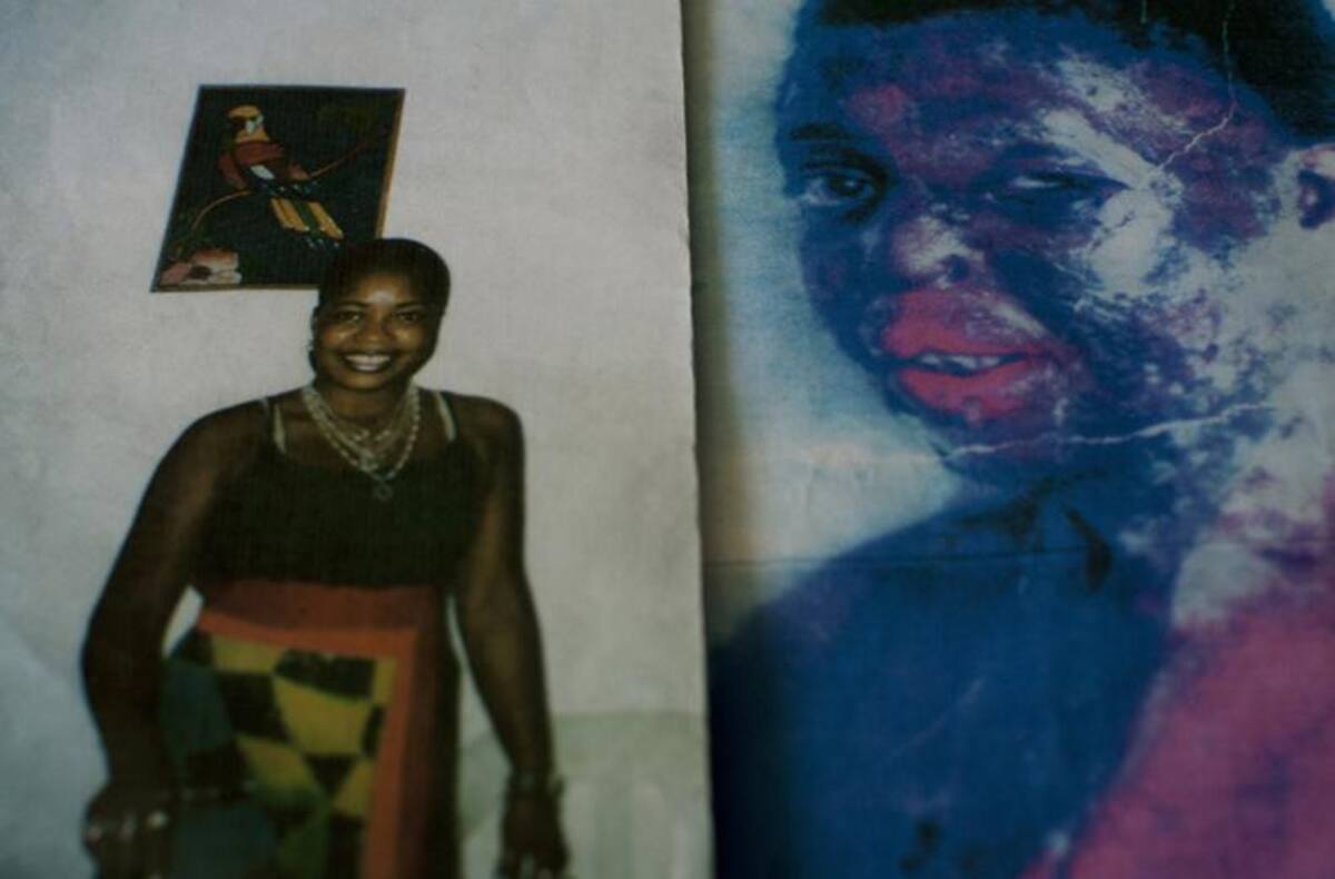 Consuela Córdoba - Quemada con ácido