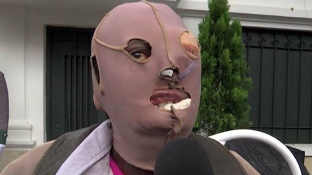 Consuela Córdoba - Quemada con ácido