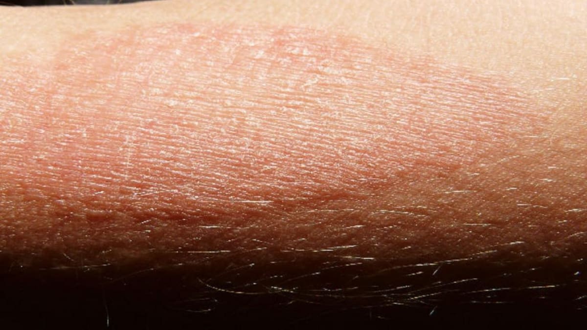 Dermatitis atópica, salud, medicina