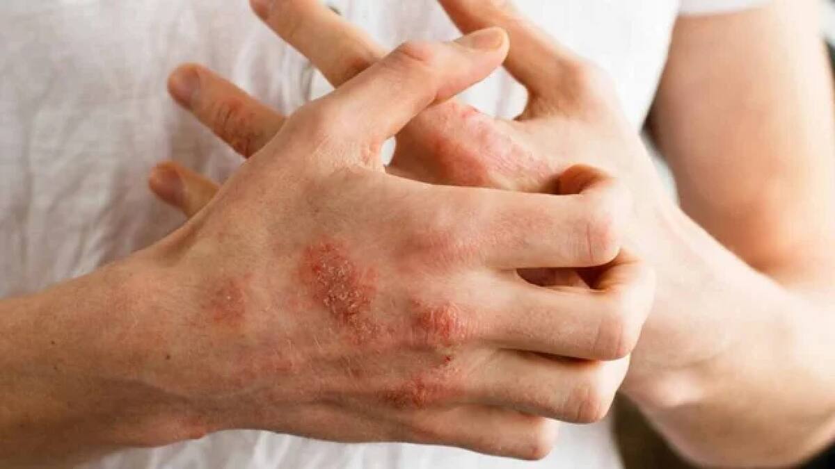 El primer tratamiento para la psoriasis pustulosa generalizada ya está disponible en Argentina. Foto NA.