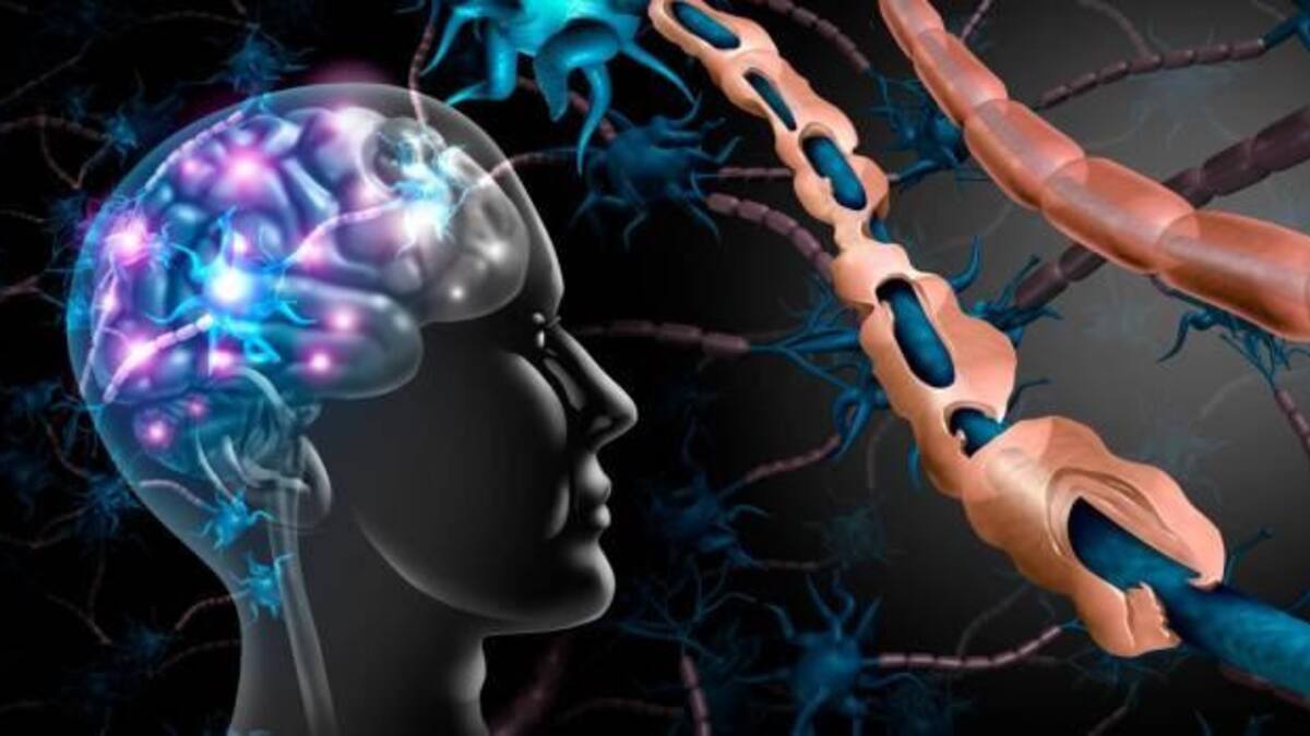 Esclerosis múltiple, salud, medicina