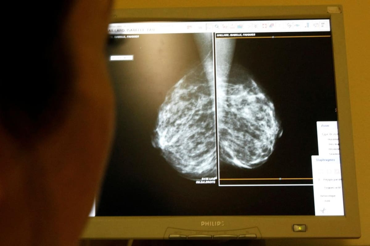 Exámenes de mamografía. Foto: Reuters