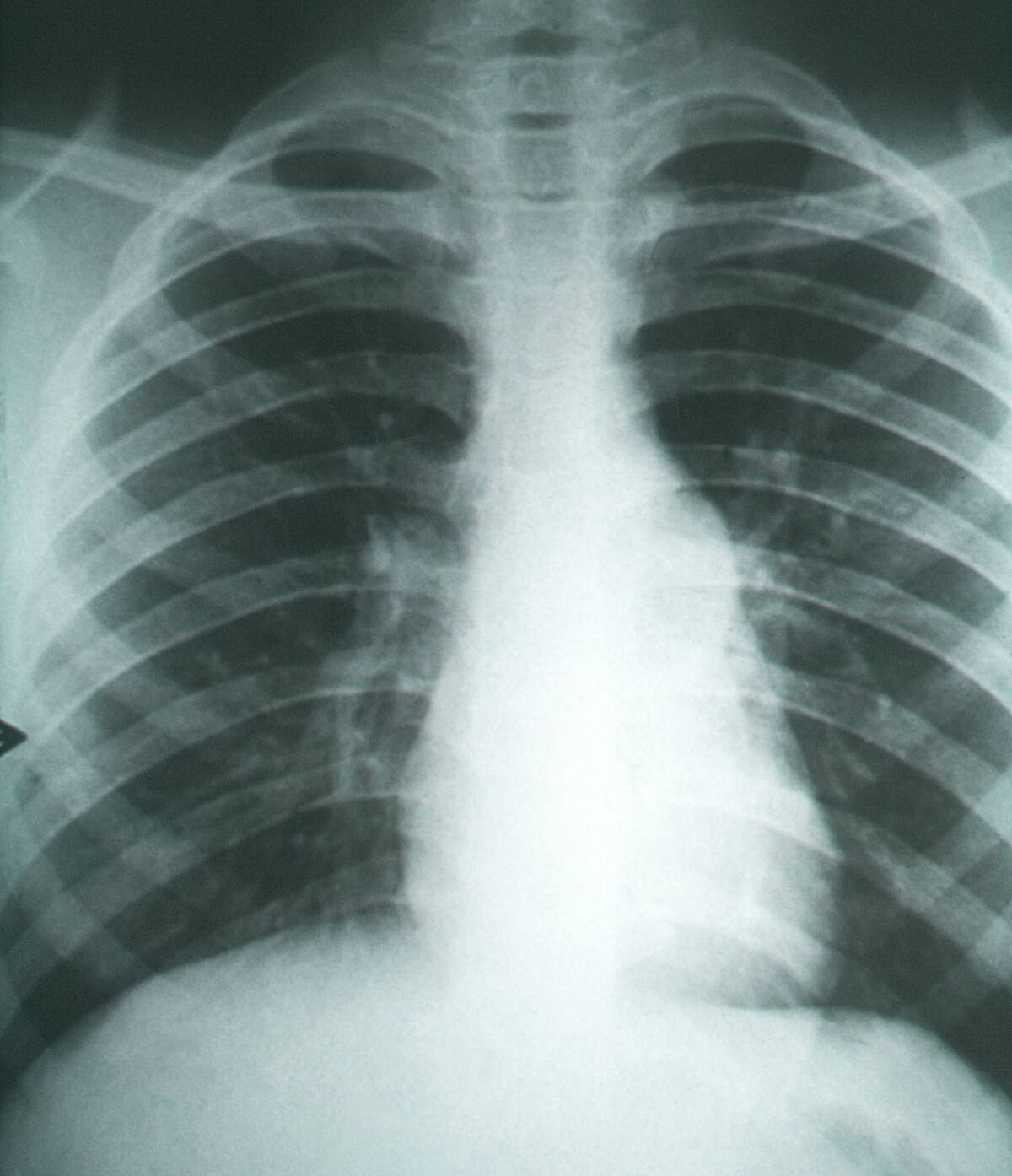 Fibrosis pulmonar secundarias a la coccidioidomicosis.. Foto: Wikipedia.
