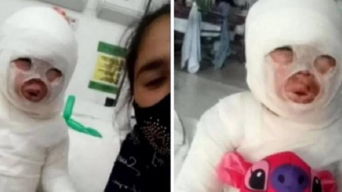 Florencio Varela: una empleada de un restaurante se tropezó y le volcó aceite hirviendo a una nena de 3 años