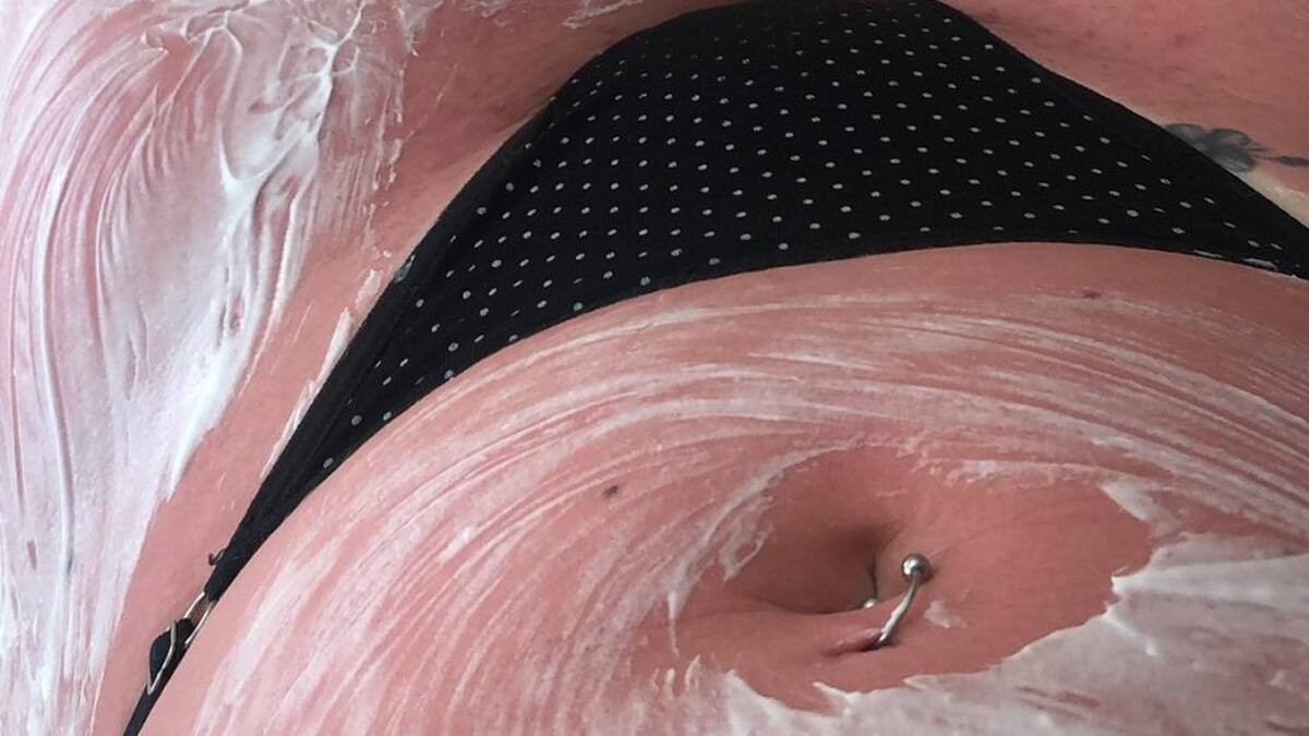 Fue a la cama solar y terminó internada con quemaduras graves