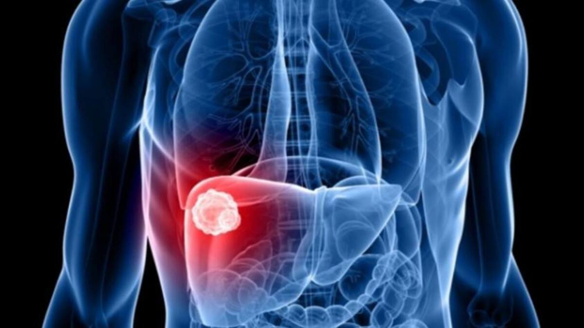 Día mundial contra la Hepatitis: más del 50% de las personas no saben que tienen la enfermedad