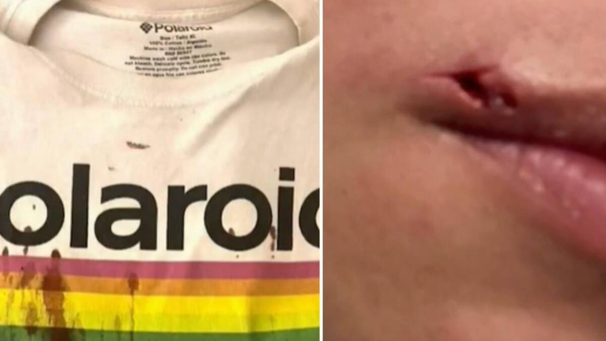 Pareja gay denunció que fue golpeada y recibió insultos sobre viruela del mono