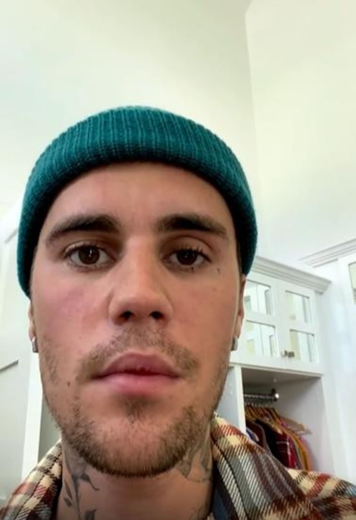 Justin Bieber con parálisis facial. Foto: captura instagram/justinbieber