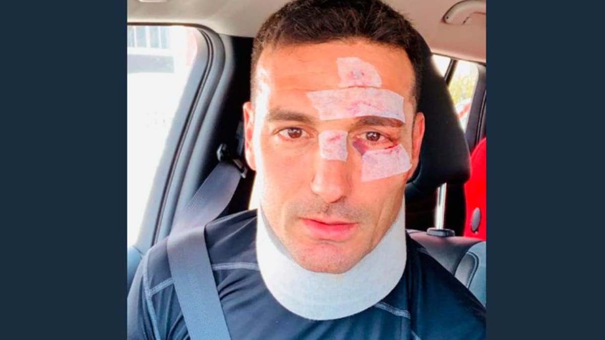 Lionel Scaloni tras accidente vial en Mallorca