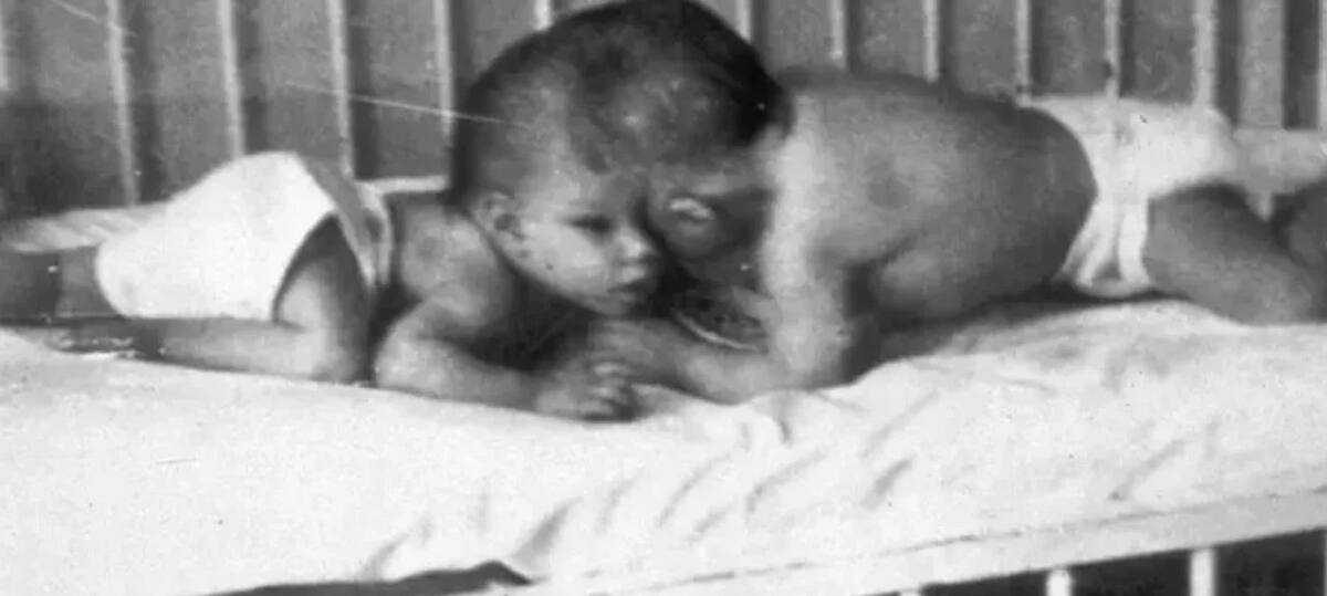 Lori y George Schappell, los gemelos siameses más viejos del mundo. Foto: NA.