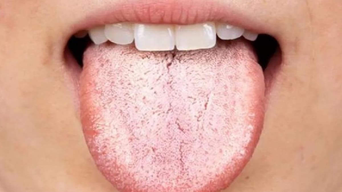 Brote de sífilis en Argentina: ¿por qué tener la lengua blanca puede ser un síntoma?