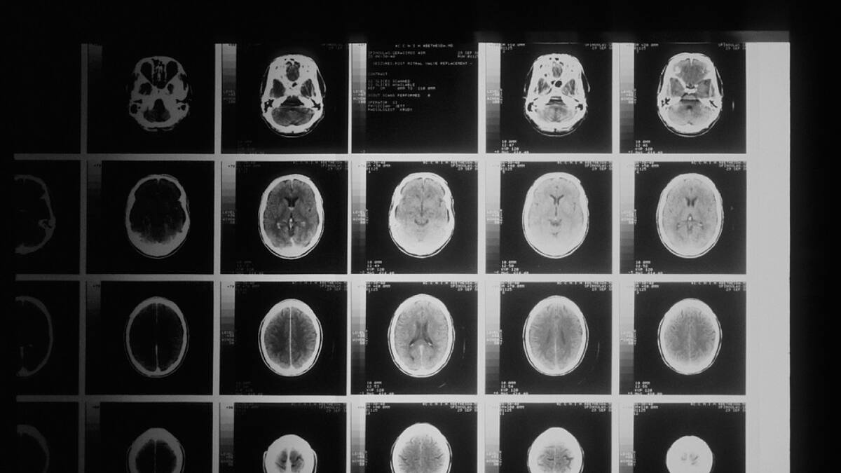 Tumores cerebrales. Foto: Unsplash.