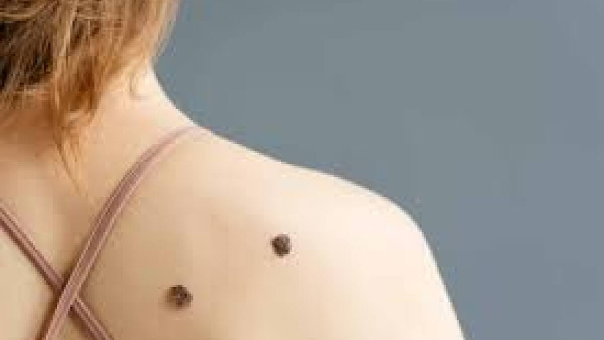 Melanoma, el tipo de cáncer de piel más grave. Foto: MSD