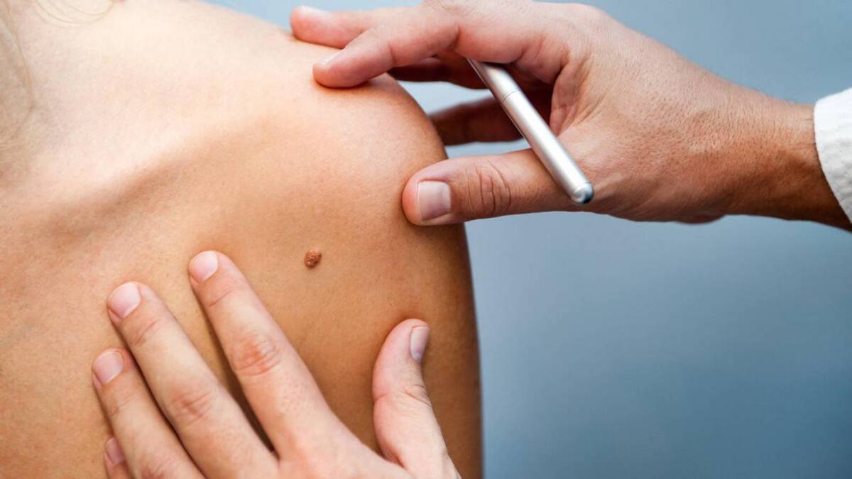 Melanoma, cáncer de piel. Foto: iStock