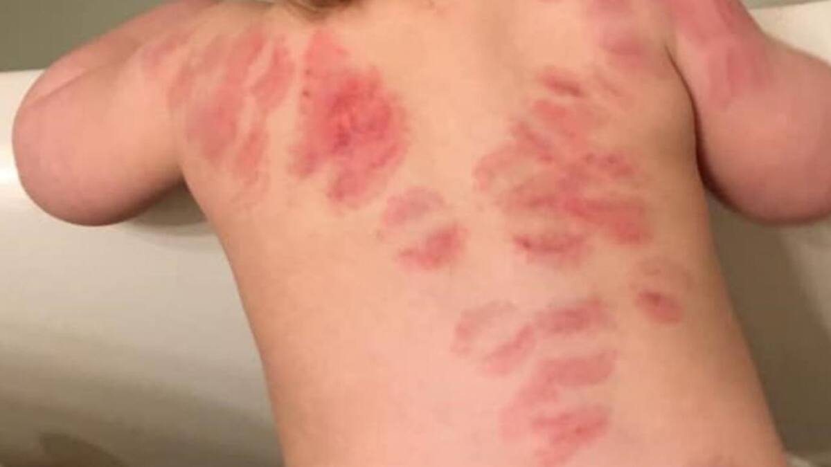 Niño mordido más de 25 veces en una guardería