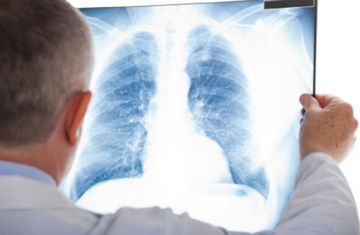 Nueva droga para un subtipo de cáncer de pulmón