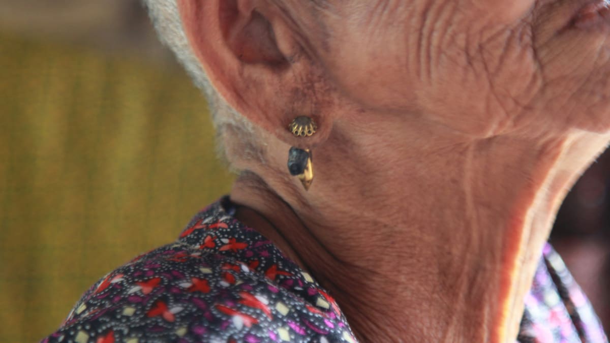 Fue al médico por un dolor en el oído y sorprendió a todos con lo que tenía dentro