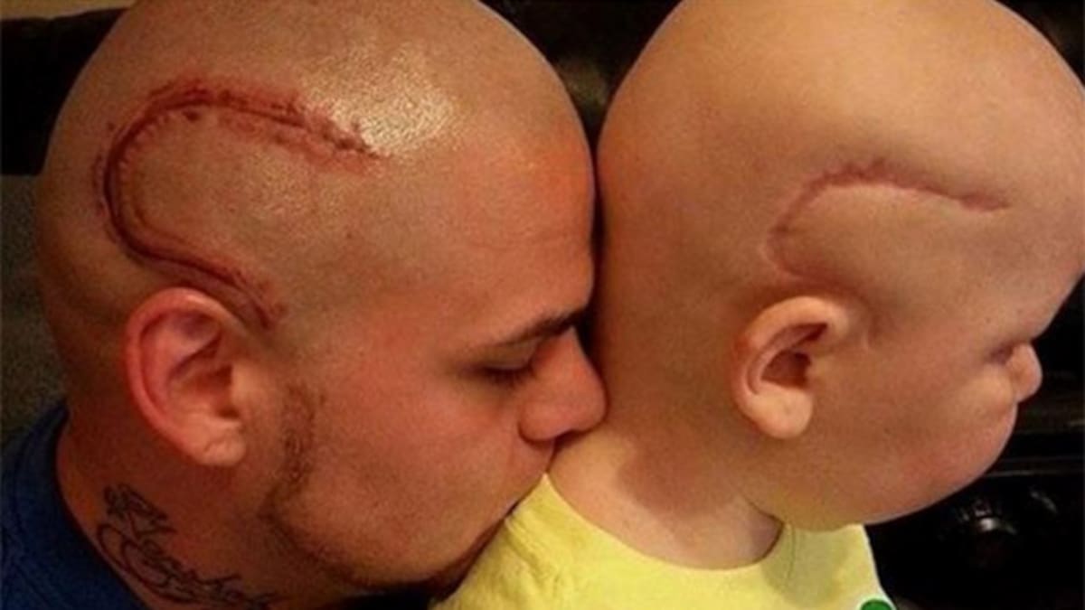 Padre se tatuó cicatriz