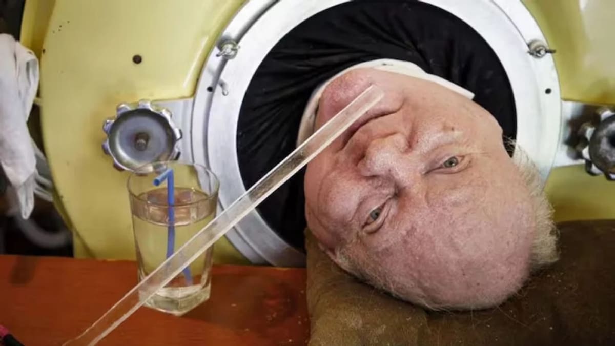 Paul Alexander, hombro que vivió 70 años con un pulmón de acero. Foto: NA.