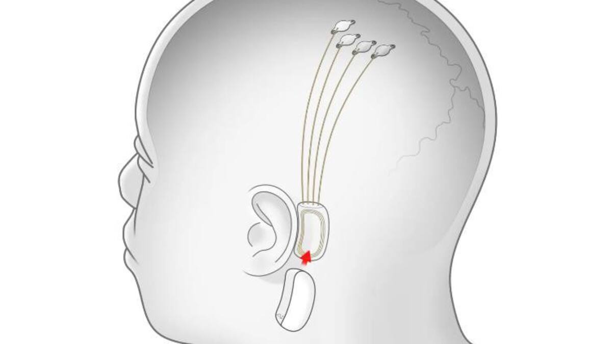 Propuesta de las primeras instalaciones de Neuralink. Foto: Neuralink