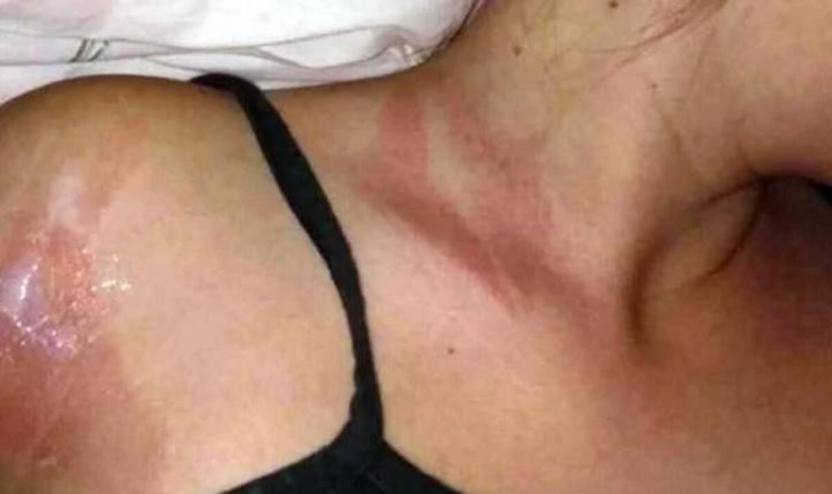 Quemaduras de joven de Río Negro por líquido de funda de celular