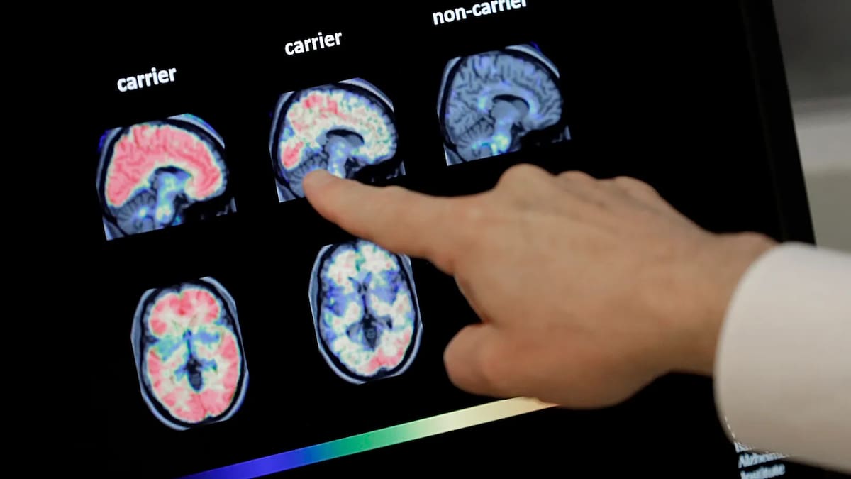 Cáncer y Alzheimer: el sorprendente vínculo que podría cambiar la forma de investigar ambas enfermedades