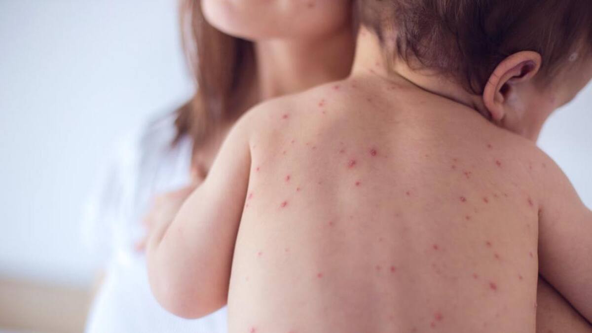 Vacunación abierta para infantes entre 6 meses y 5 años tras un nuevo brote de sarampión. Foto: Web.