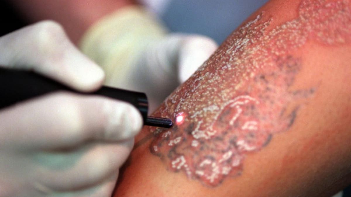 Se quiso borrar el tatuaje con nombre de su exesposa y todo resulta un desastre