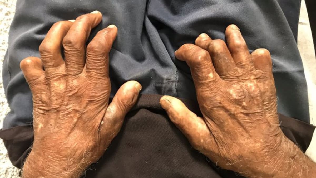 Chile se convirtió en el primer país de América en ser verificado como libre de lepra