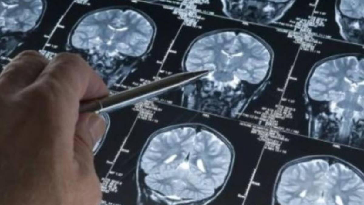 Tenias en el cuerpo de un hombre que comió carne mal cocida