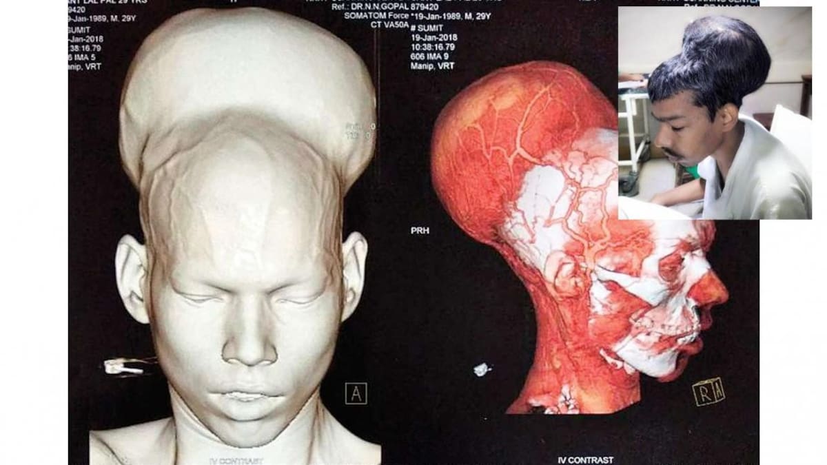 Tumor - India
