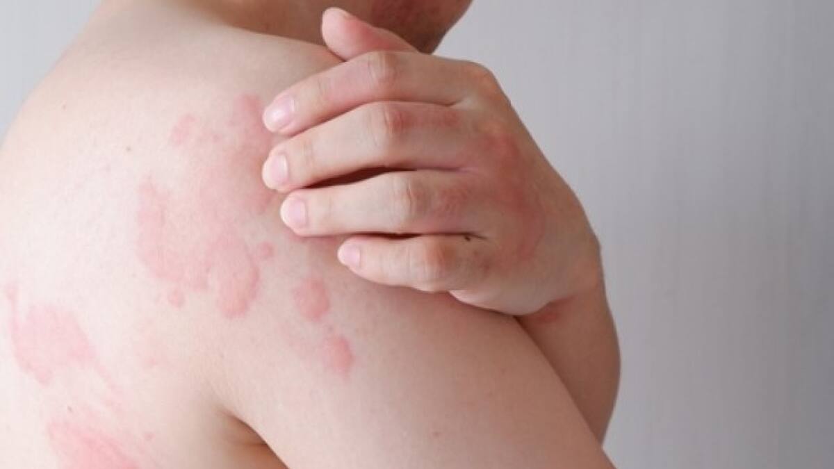 Los principales síntomas de la Urticaria crónica. Foto: X