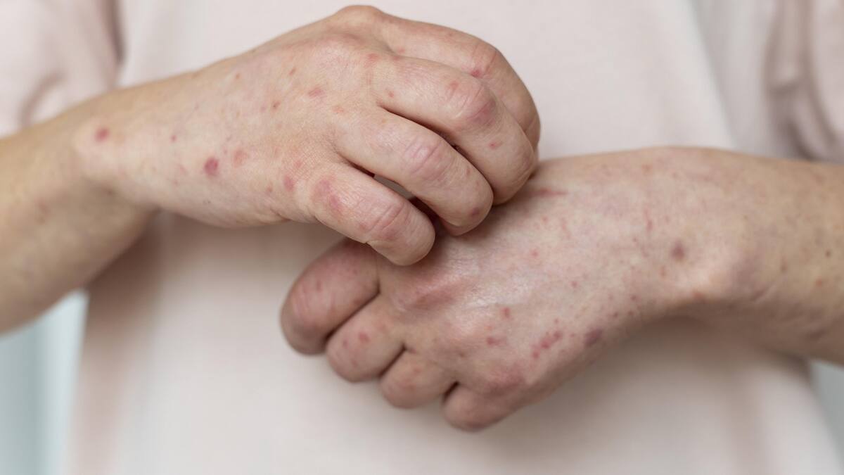 Alerta por un nuevo caso importado de sarampión en el país: Salud emitió una alerta epidemiológica