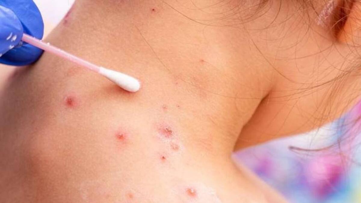 Viruela del mono. Foto: NA.